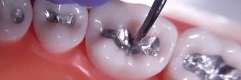 Laser And Amalgam Filling Hew Hope Medical Center Dental Dentist Department